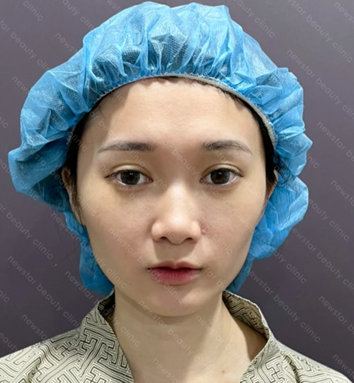 自體脂肪豐臉_案例_術前(正面)
