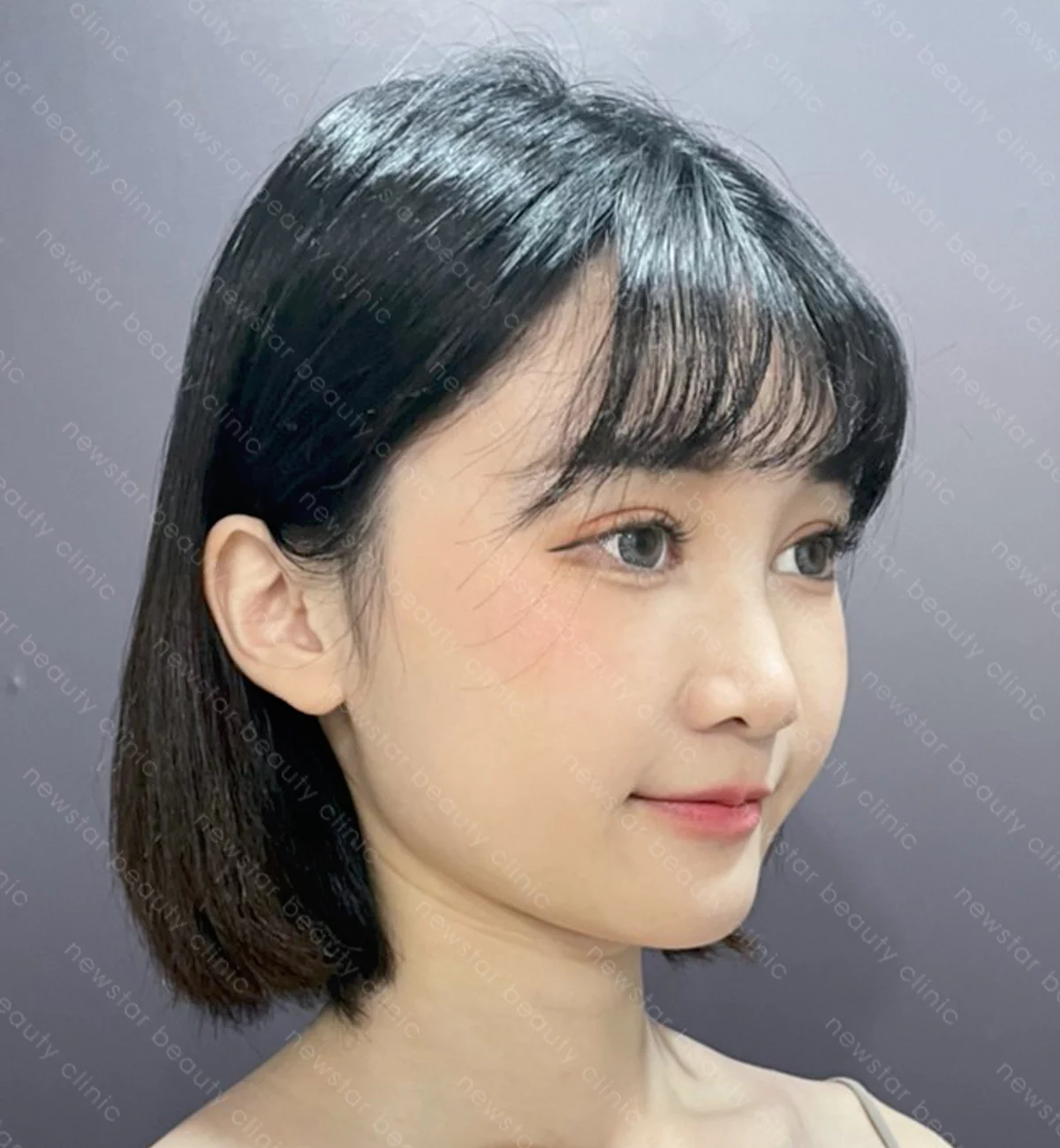 自體脂肪豐臉_案例_術後(側面)