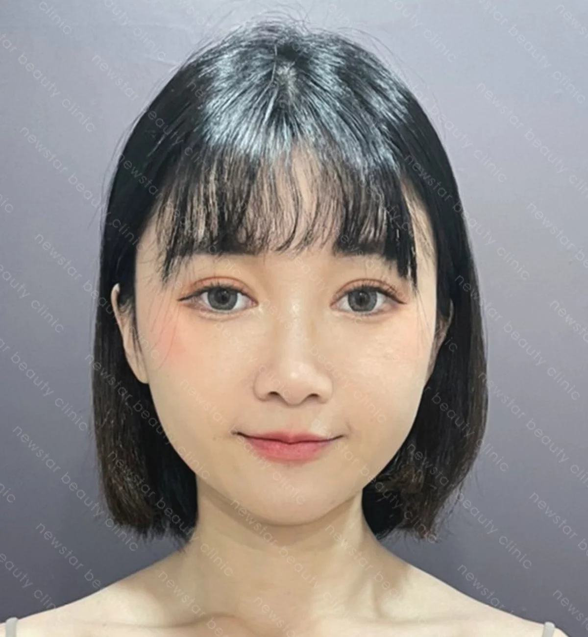 自體脂肪豐臉_案例_術後(正面)