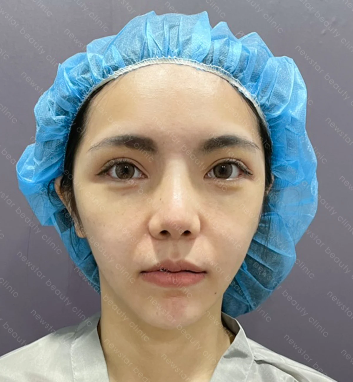 自體脂肪補臉_案例_術前(正面)