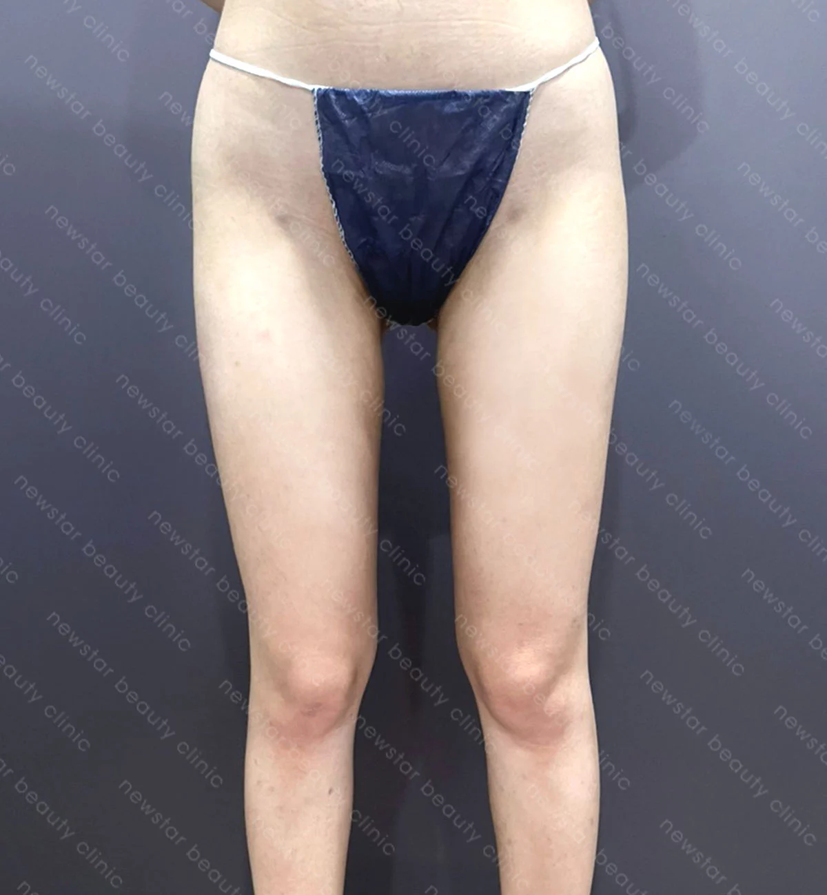 自體隆乳+大腿抽脂案例_KT_BA_大腿術後(正面)