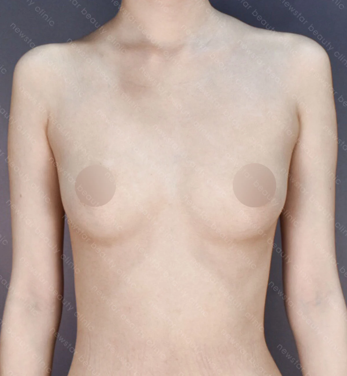 自體隆乳+大腿抽脂案例_KT_BA_胸部術前(正面)