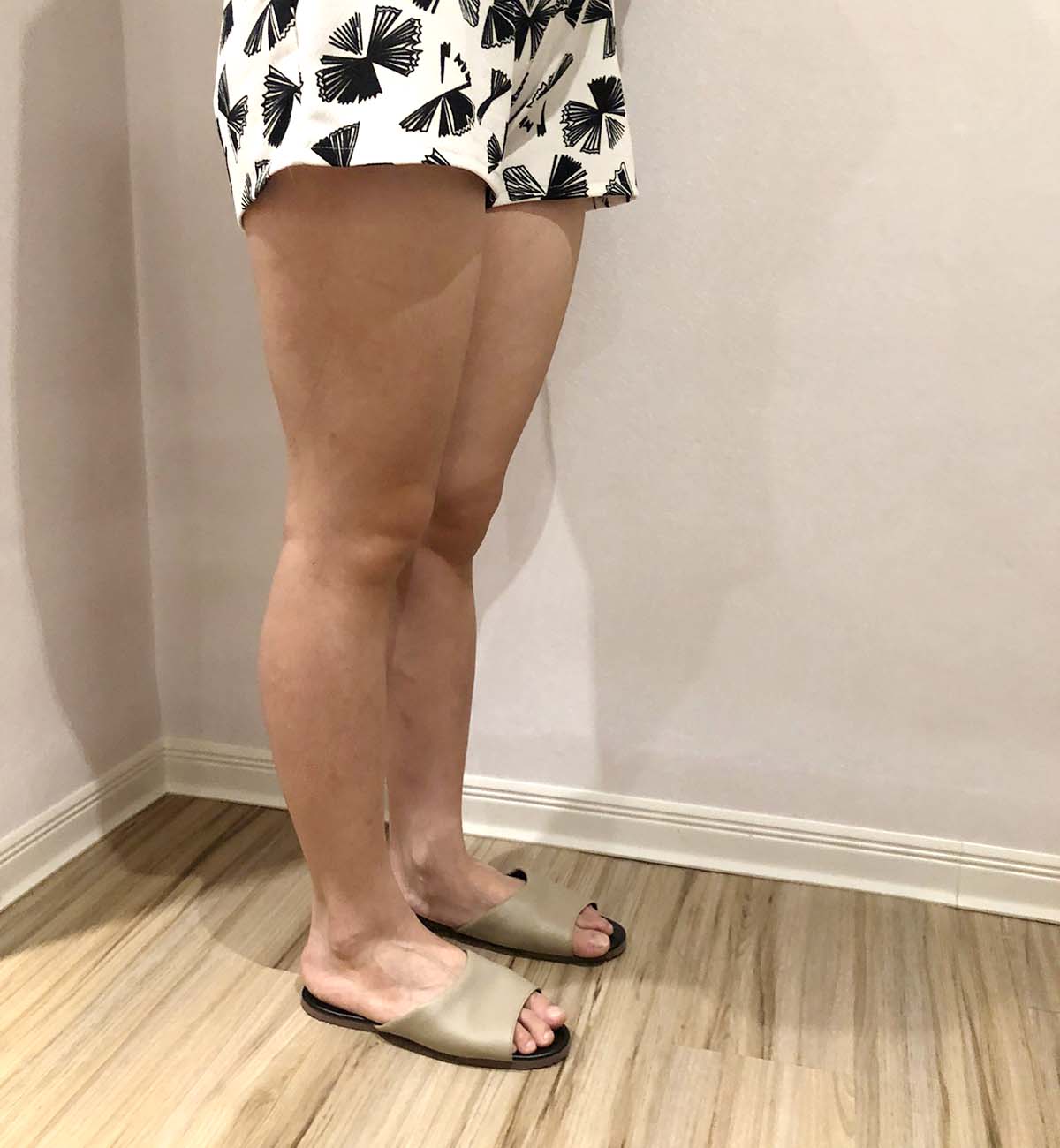 大腿抽脂手術_術前案例