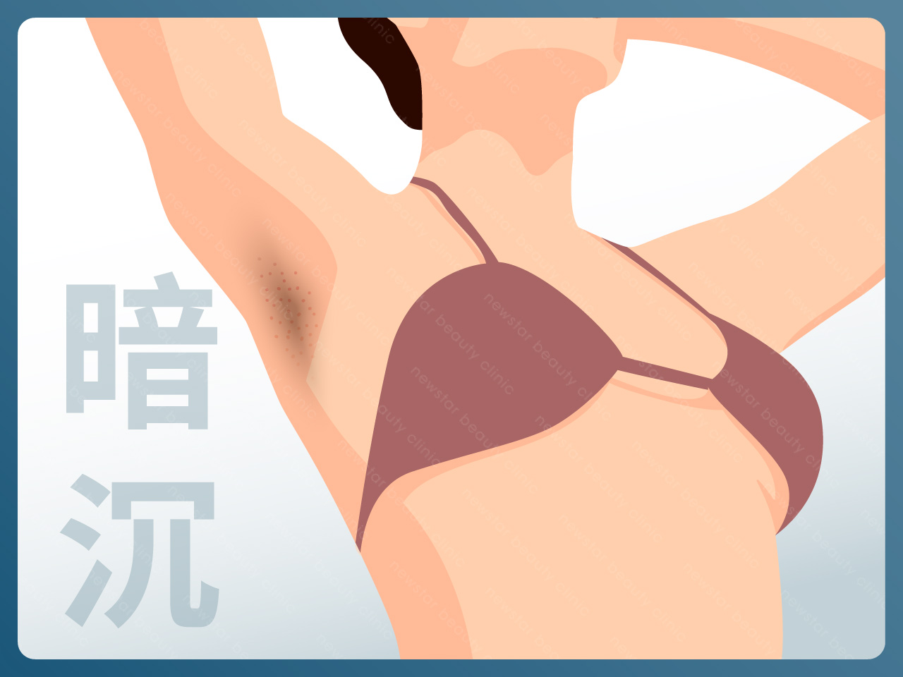 海神除毛_色素沉澱