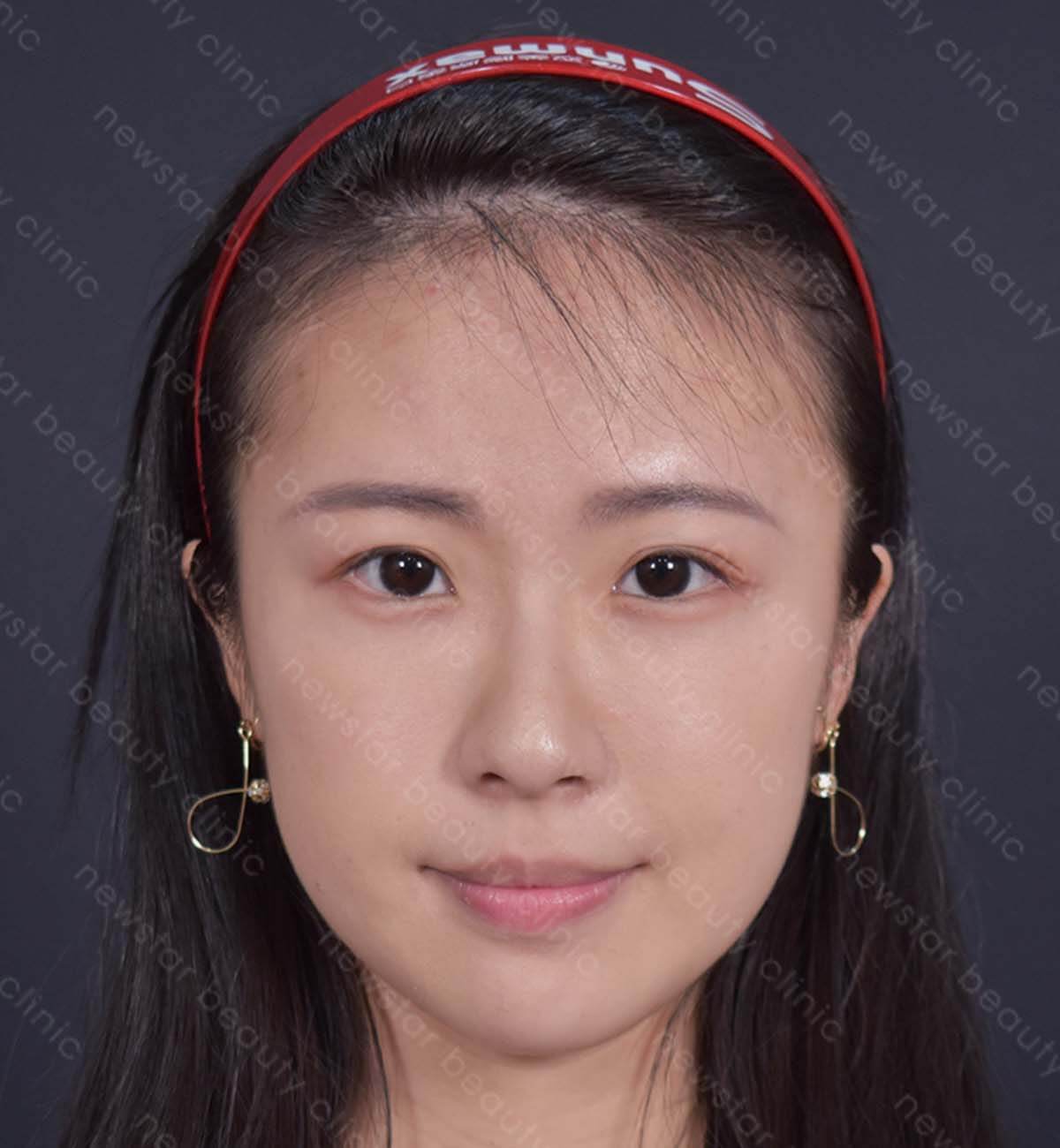 眼袋手術_術後案例
