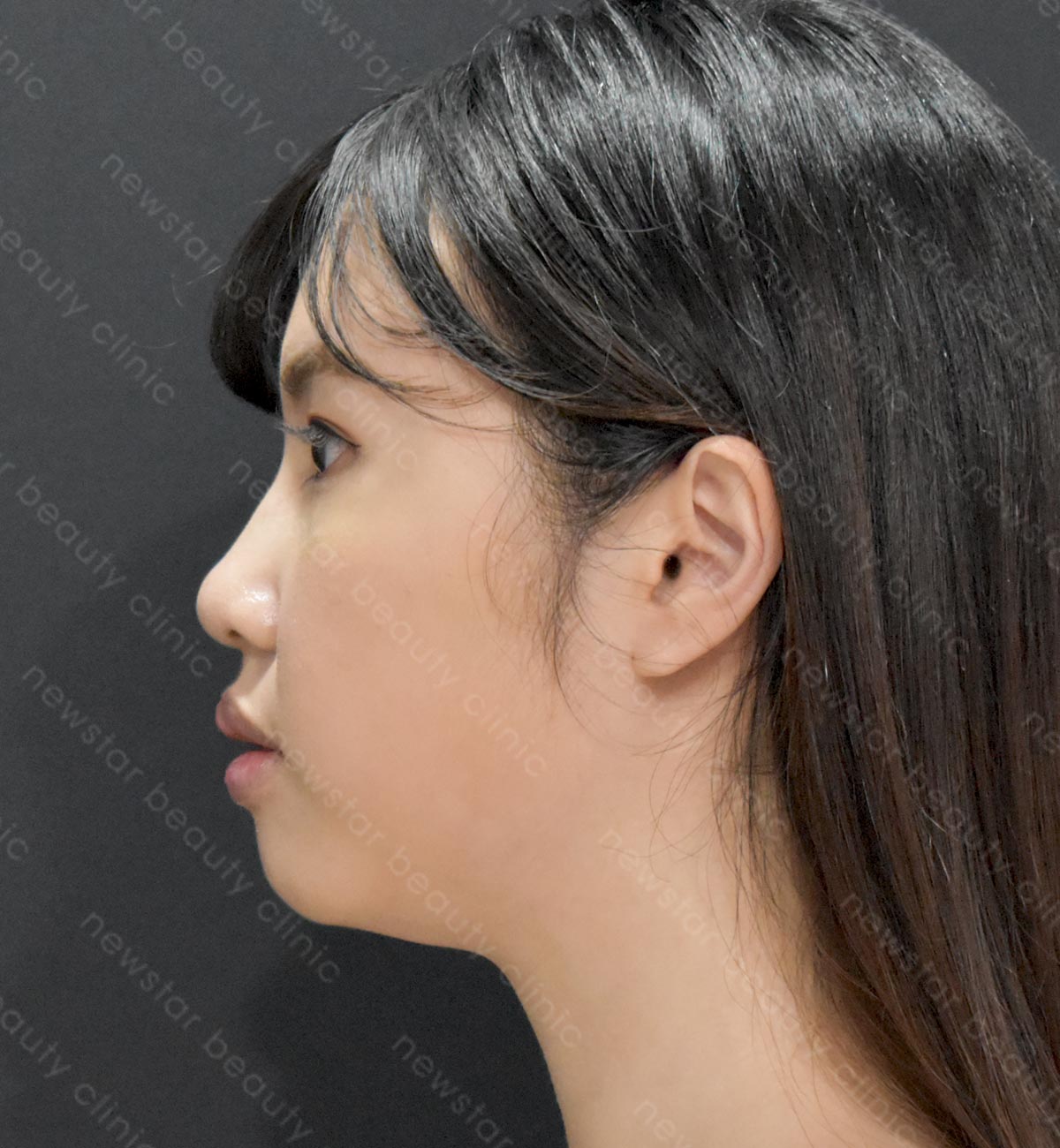 貝克脂消脂針_術前案例