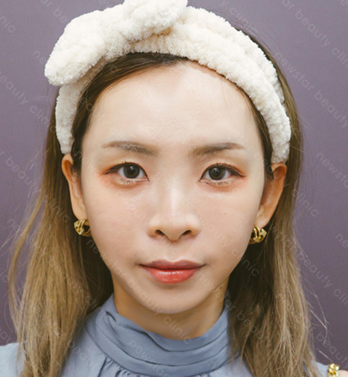 韓式鼻雕_術前案例