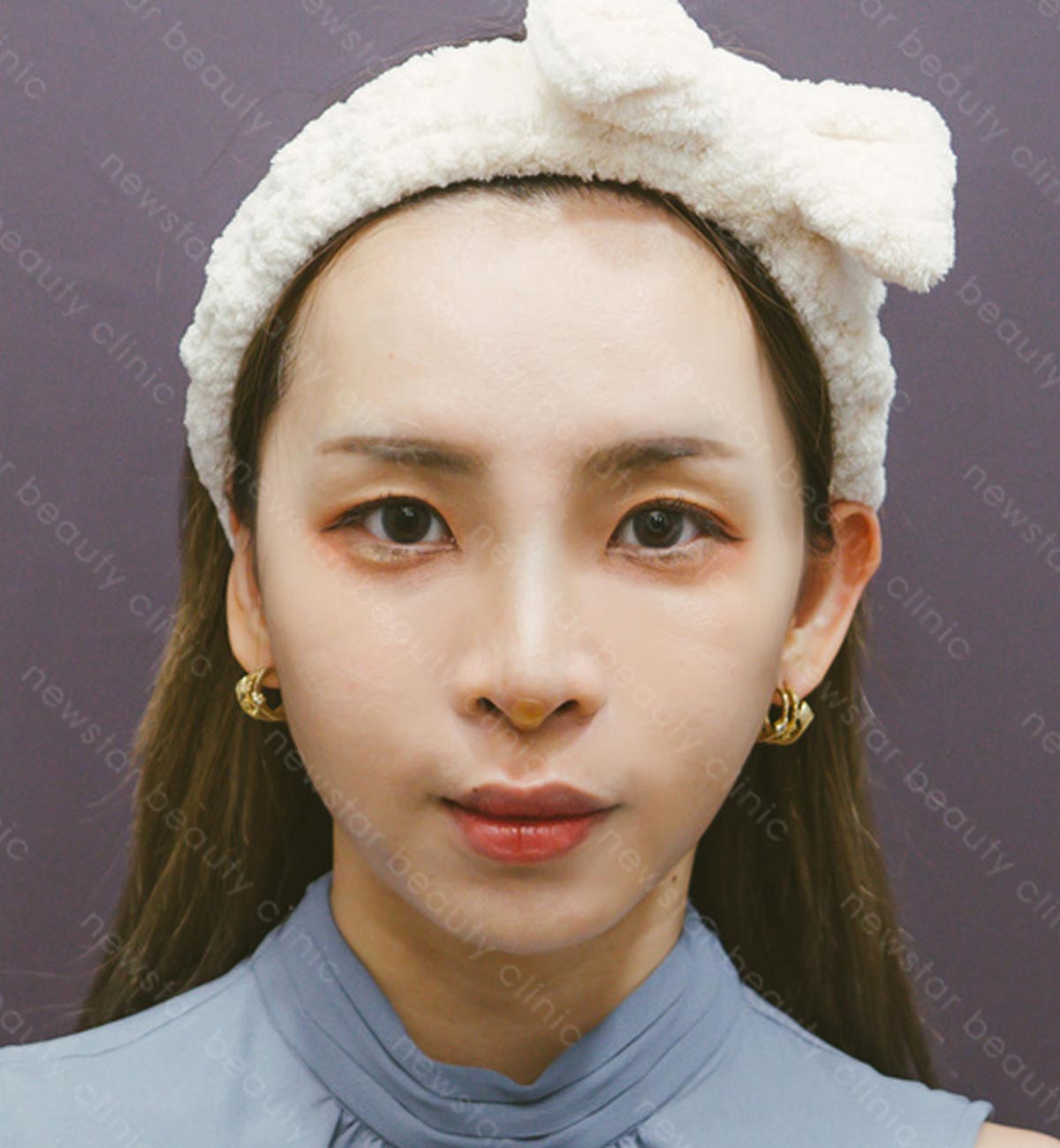 韓式鼻雕_術後案例