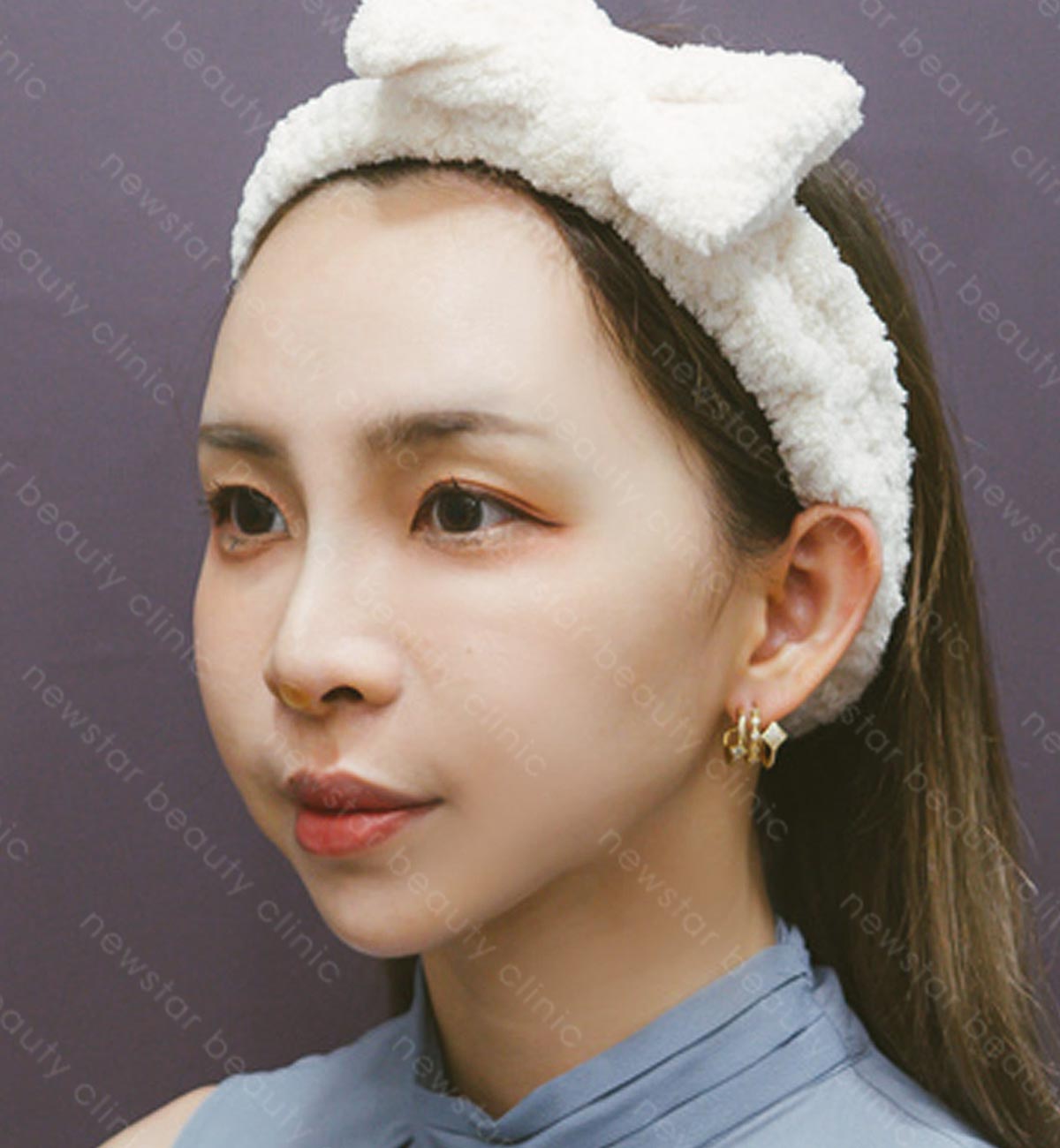 韓式鼻雕_術後案例