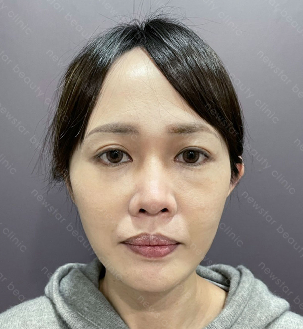 割縫雙眼皮手術_術前案例