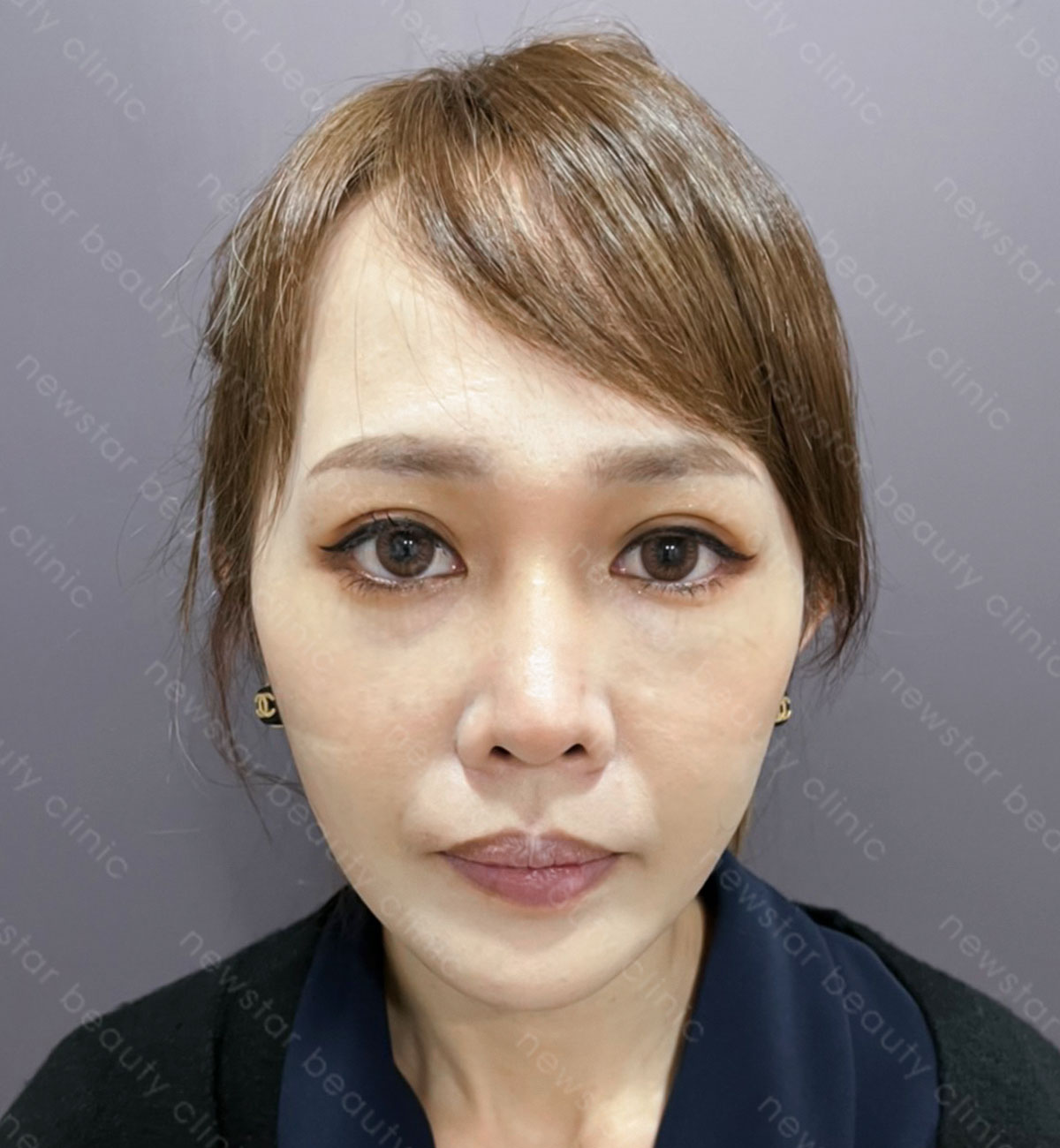 割縫雙眼皮手術_術後案例