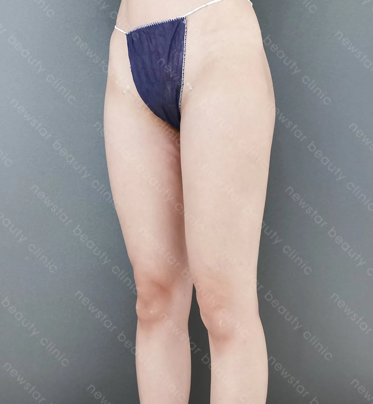 大腿抽脂案例_術前_45度
