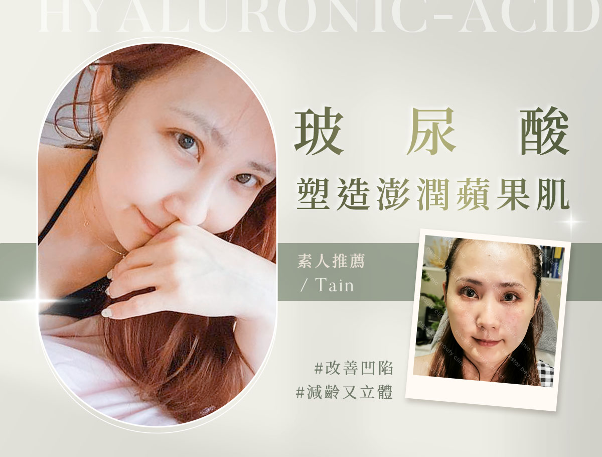 玻尿酸_微整官網案例(外BN)_亭亭