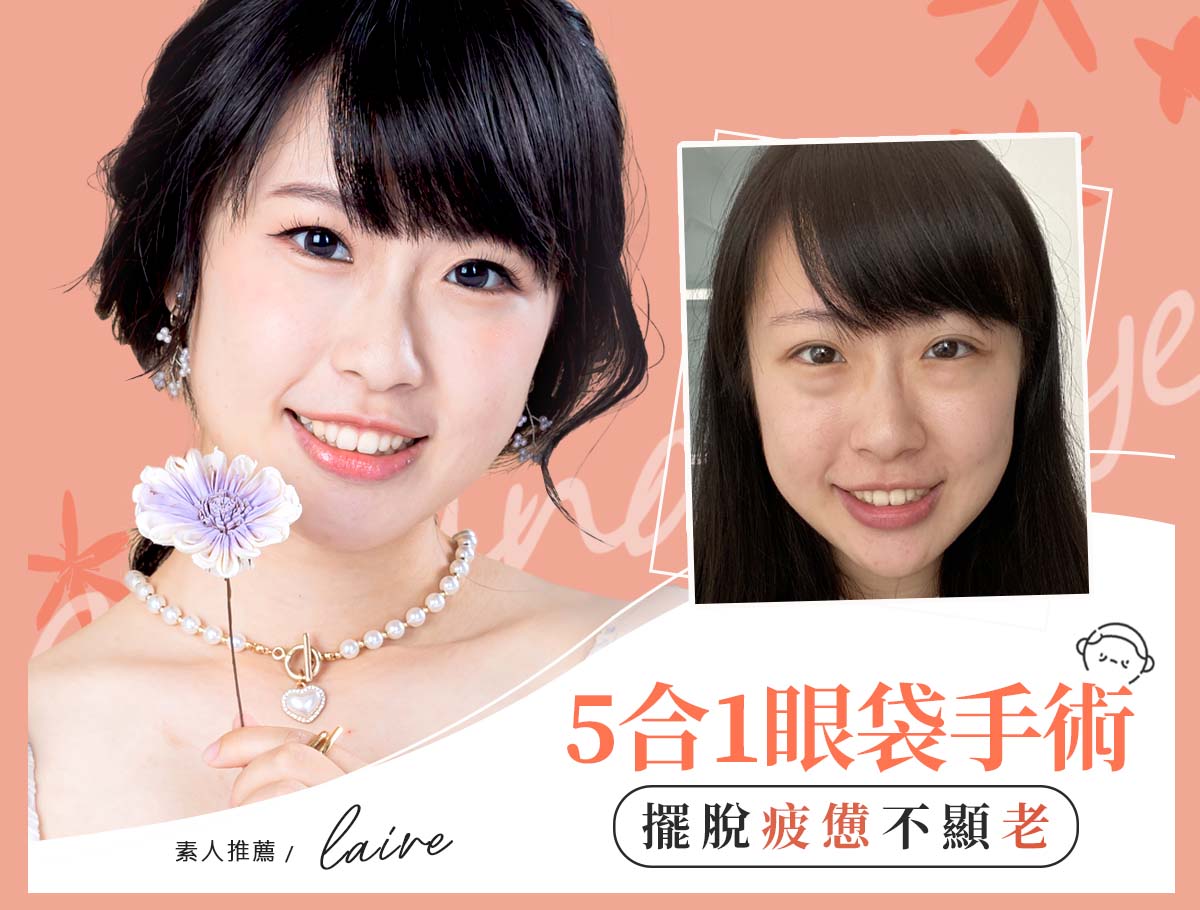 眼袋手術_案例封面