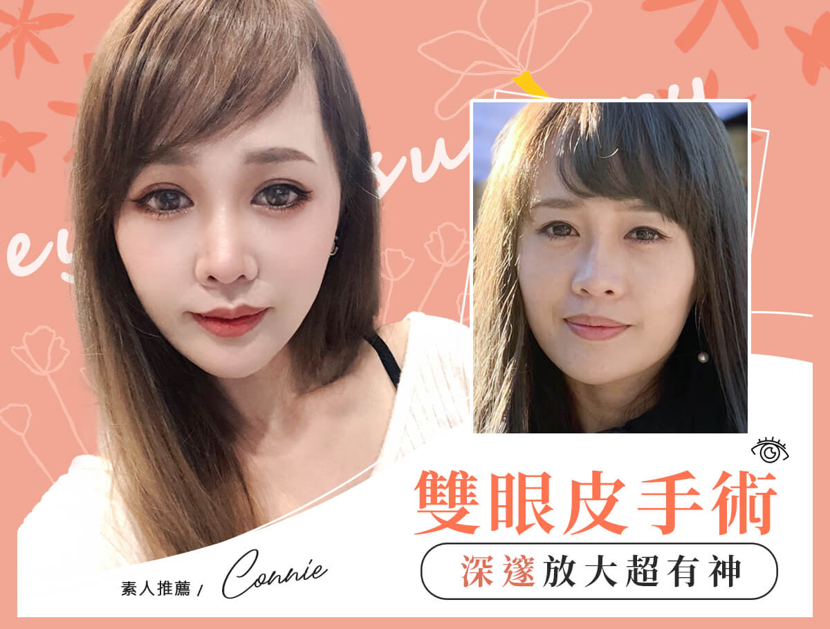割縫雙眼皮手術_案例