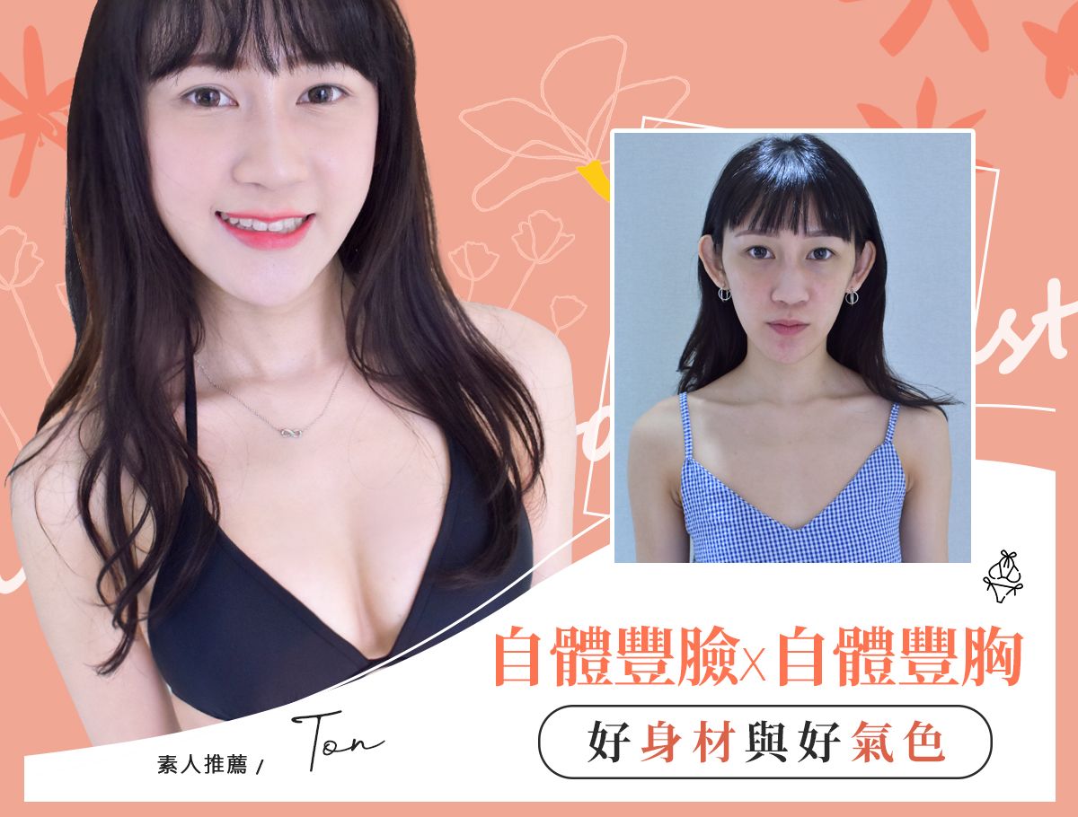 自體脂肪隆乳案例