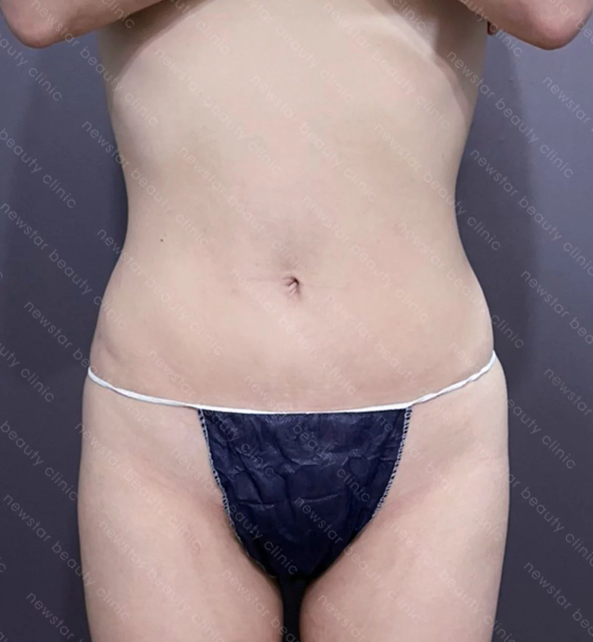 腹部抽脂素人見證案例_emma_BA術後(正面)jpg