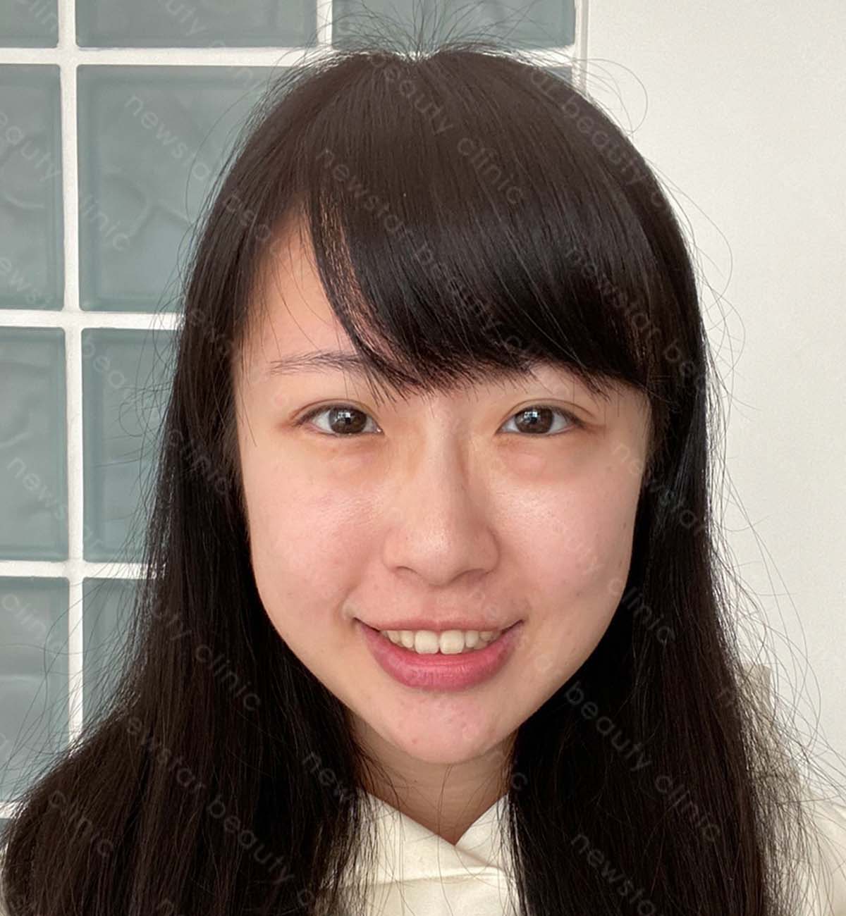 眼袋手術_術前案例