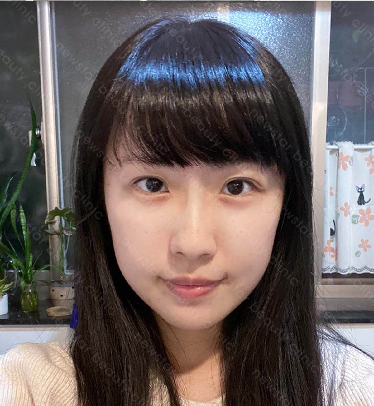 眼袋手術_術後案例