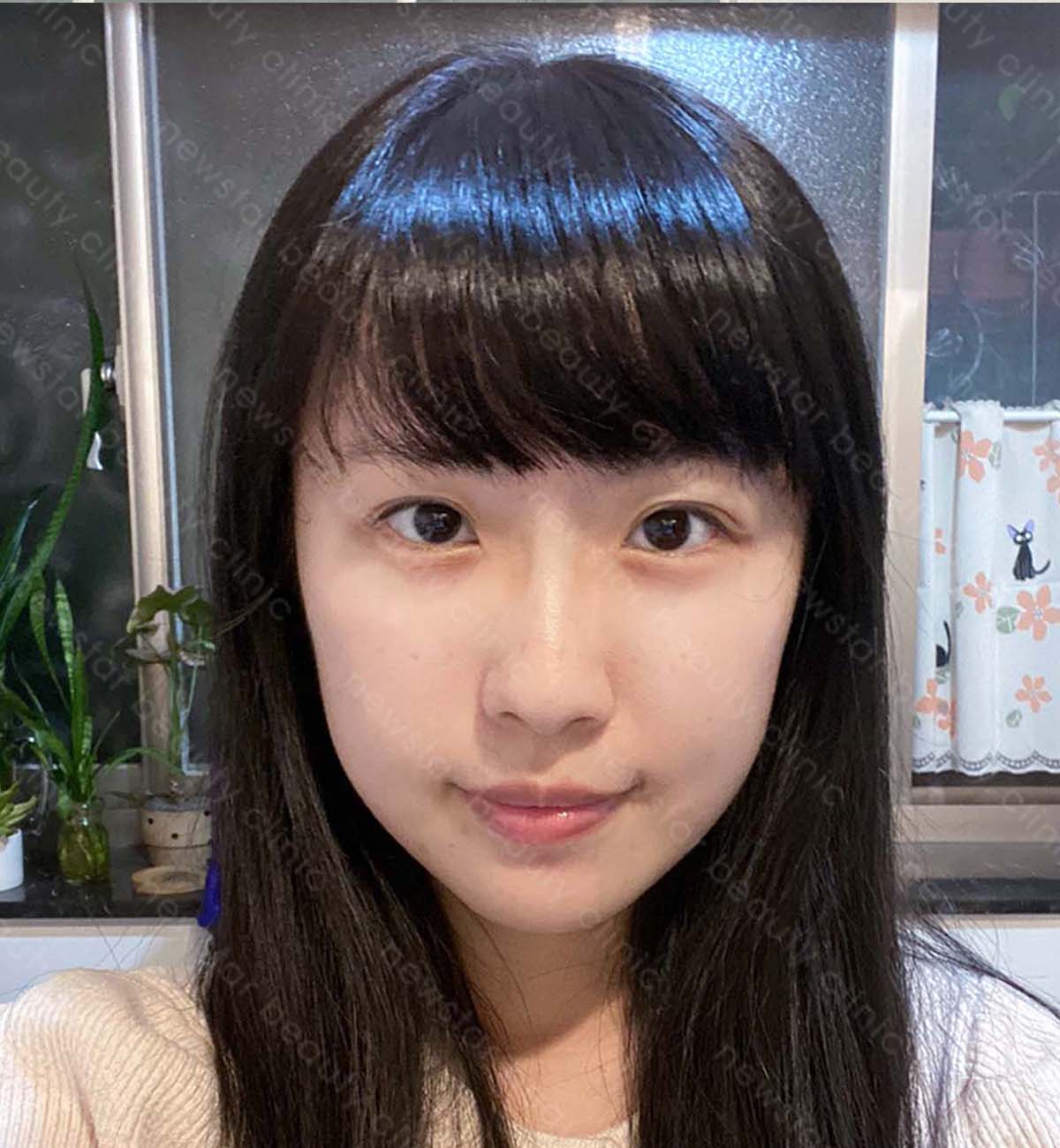 眼袋手術_術後案例
