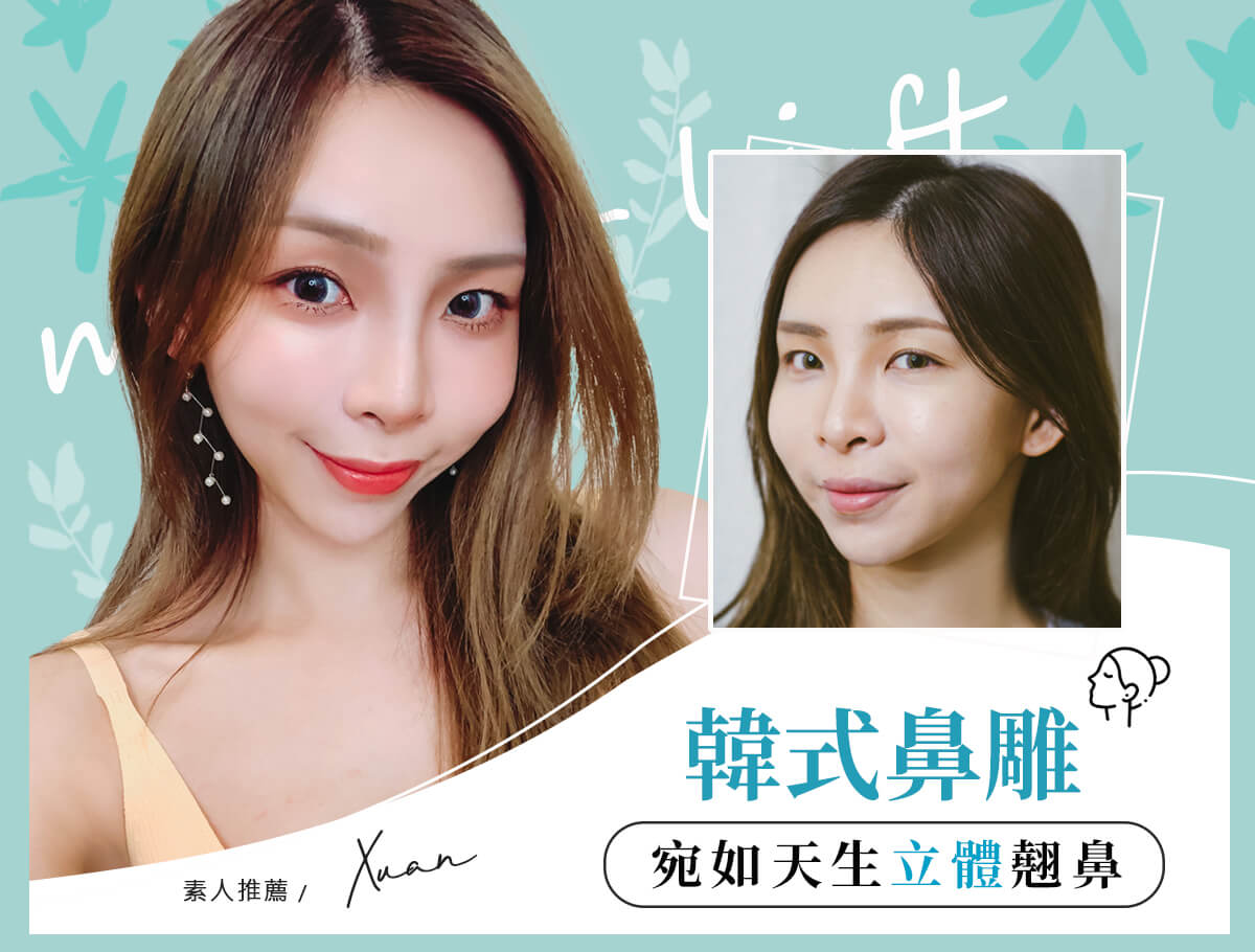韓式鼻雕_案例封面