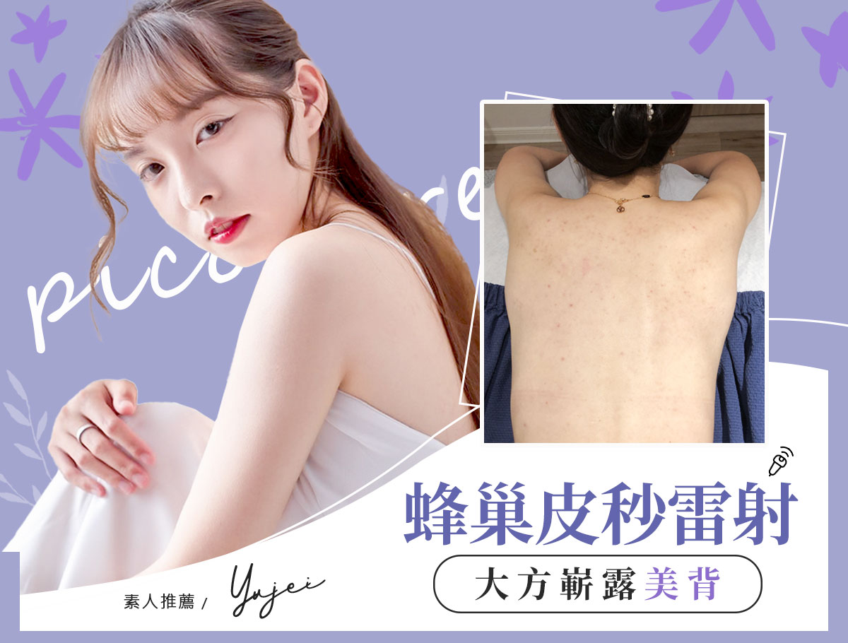 蜂巢皮秒雷射案例_結餘