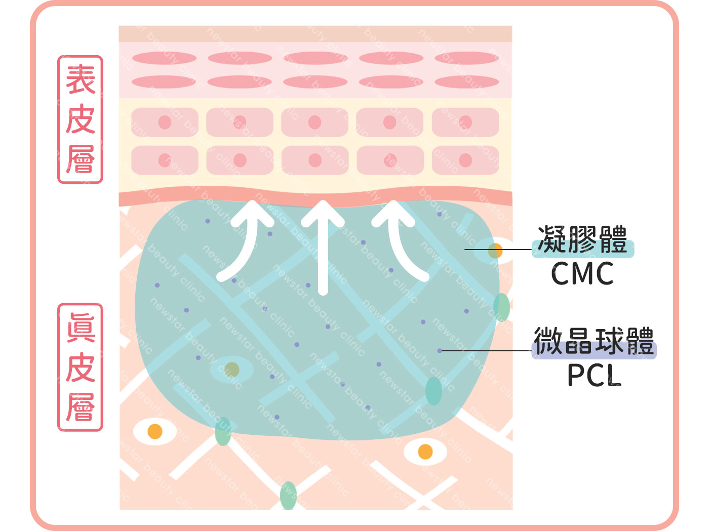 注入洢蓮絲少女針，凝膠體立即支撐凹陷處
