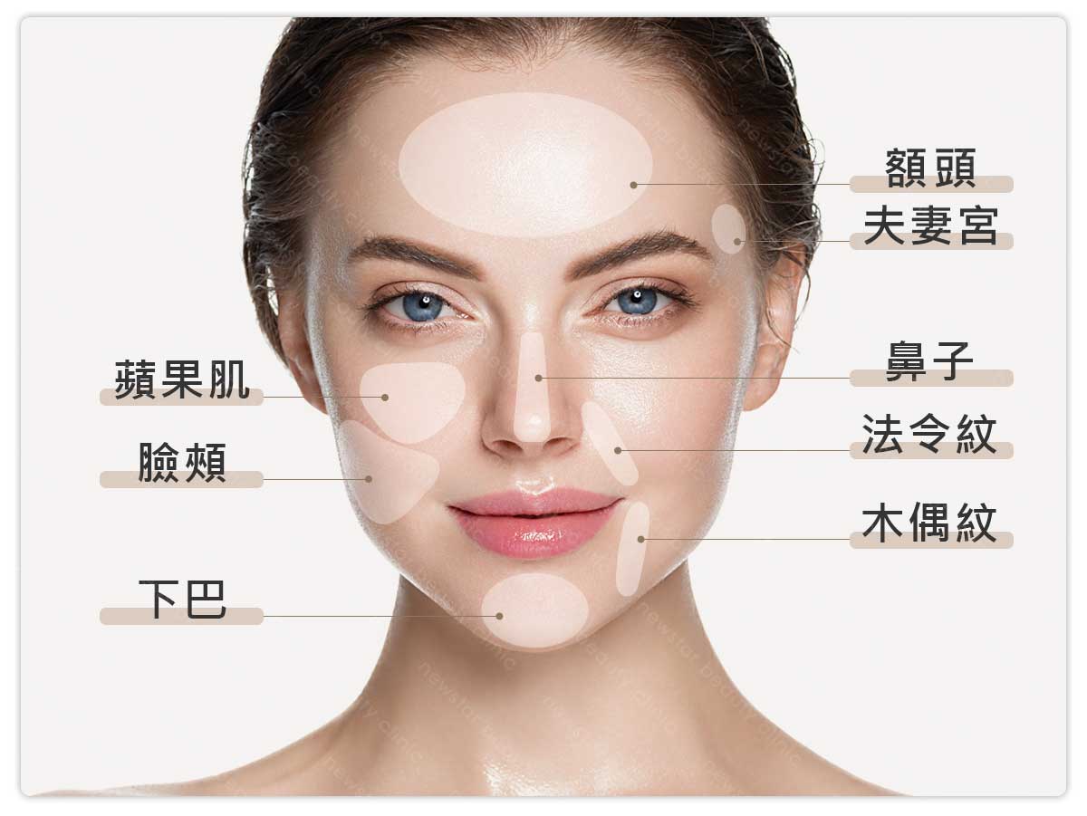 洢蓮絲注射部位