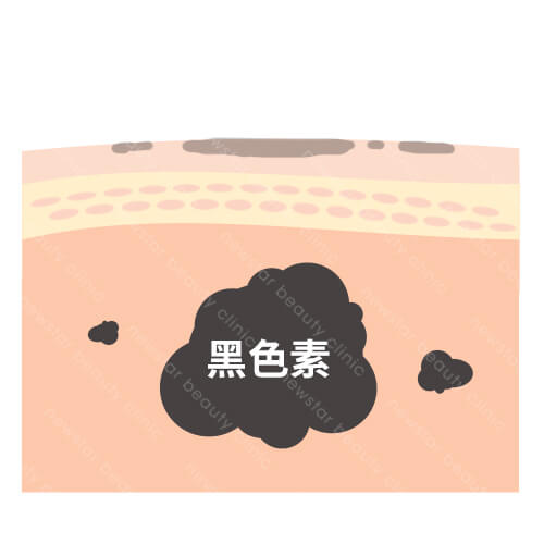 皮秒雷射_皮膚治療前色素沉澱形成色斑、黑色素