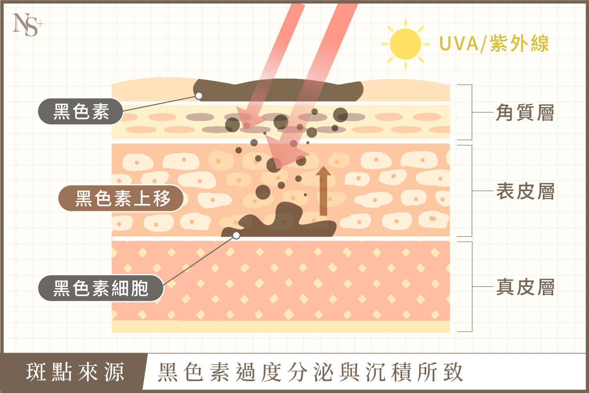 皮秒雷射_黑色素沉澱