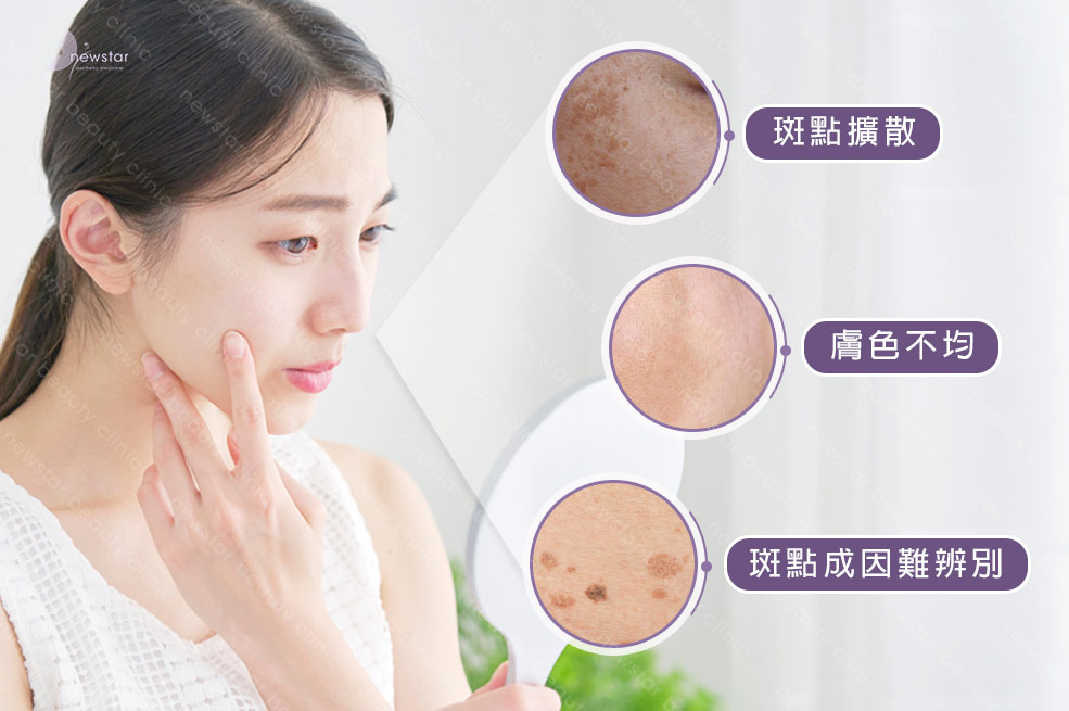 皮秒雷射_臉部斑點02