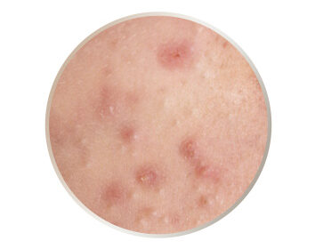 水飛梭海菲秀適用對象－痘痘、粉刺