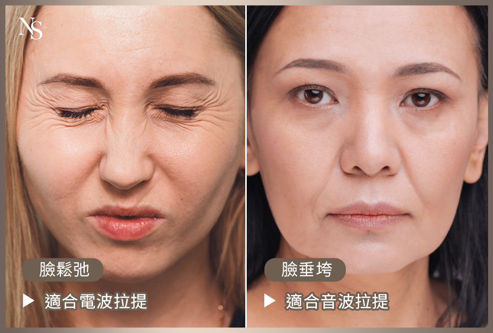 鳳凰電波_需要音波還是電波_臉鬆 臉垂