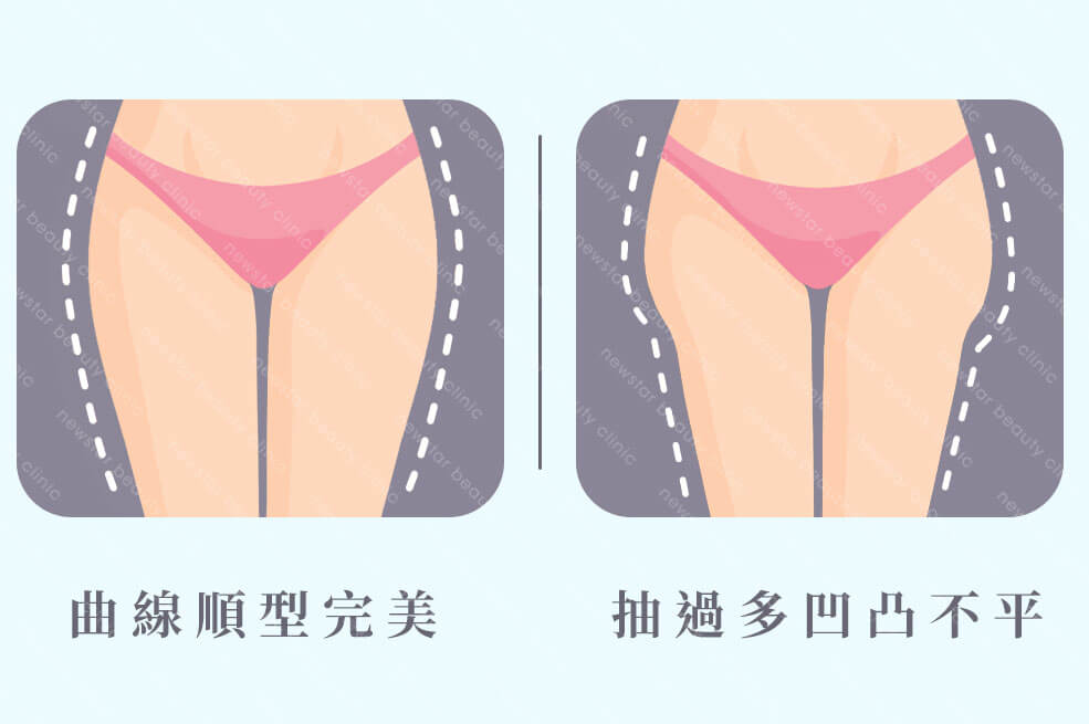 抽脂復胖_抽脂量