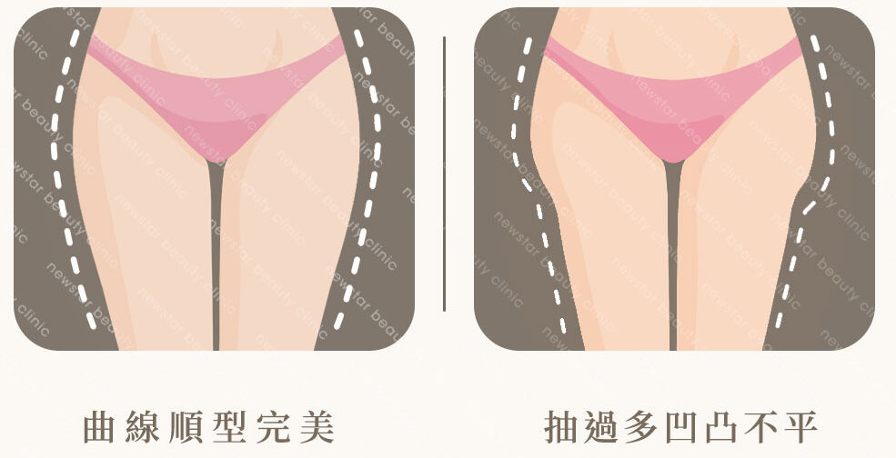 抽脂復胖_抽多划算