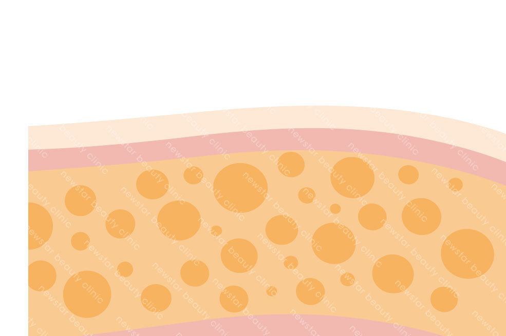 抽脂復胖_手術原理術前