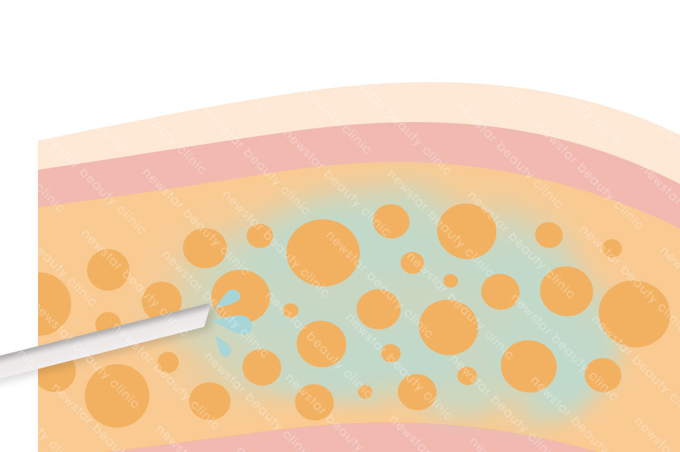 抽脂復胖_注入膨脹的液體