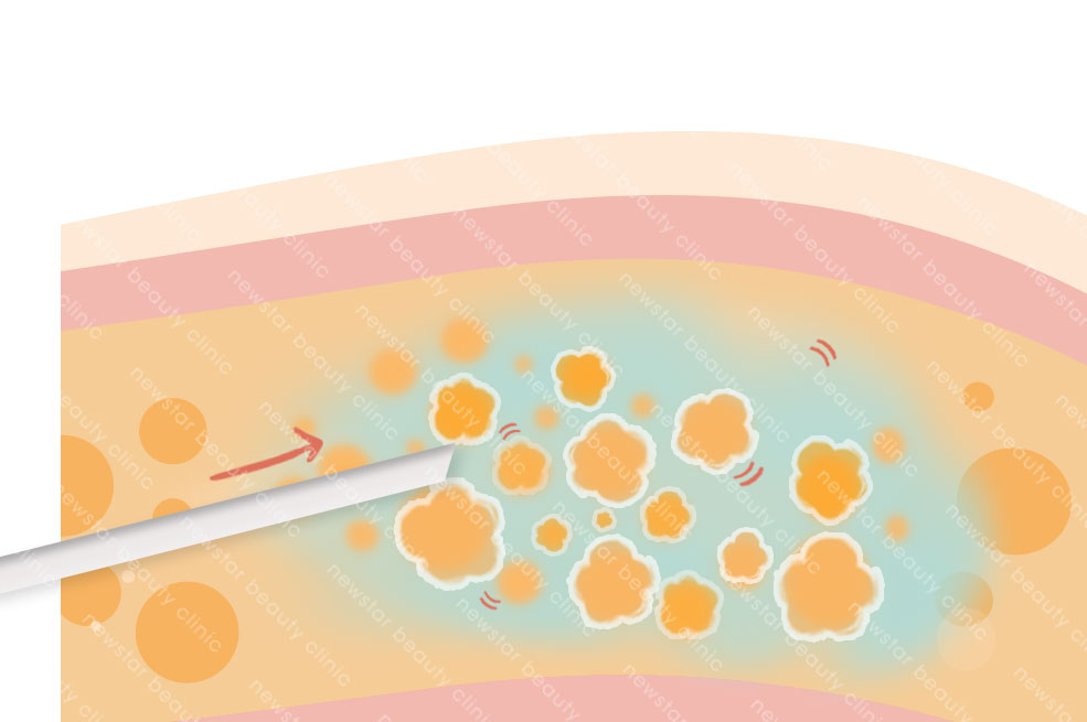 抽脂復胖_脂肪乳糜化