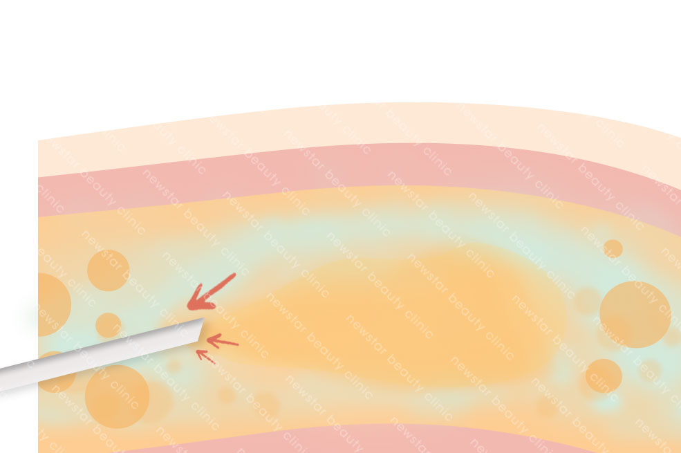 抽脂復胖_吸出脂肪
