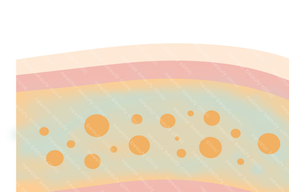 抽脂復胖_抽脂術後