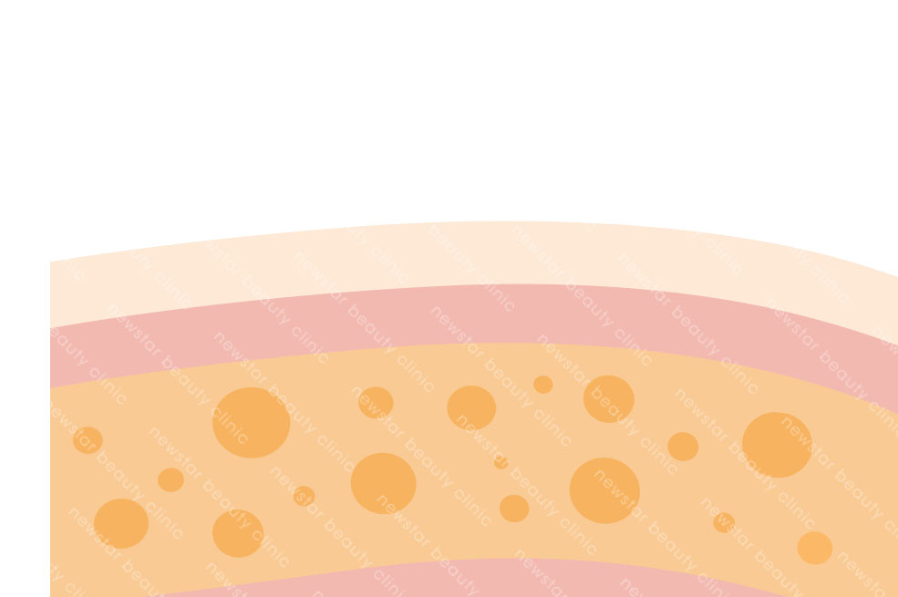 抽脂復胖_術後恢復