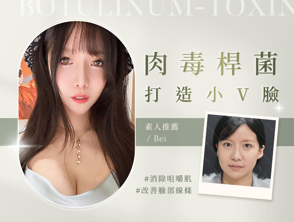 肉毒_微整官網案例(外BN)_貝貝蕾