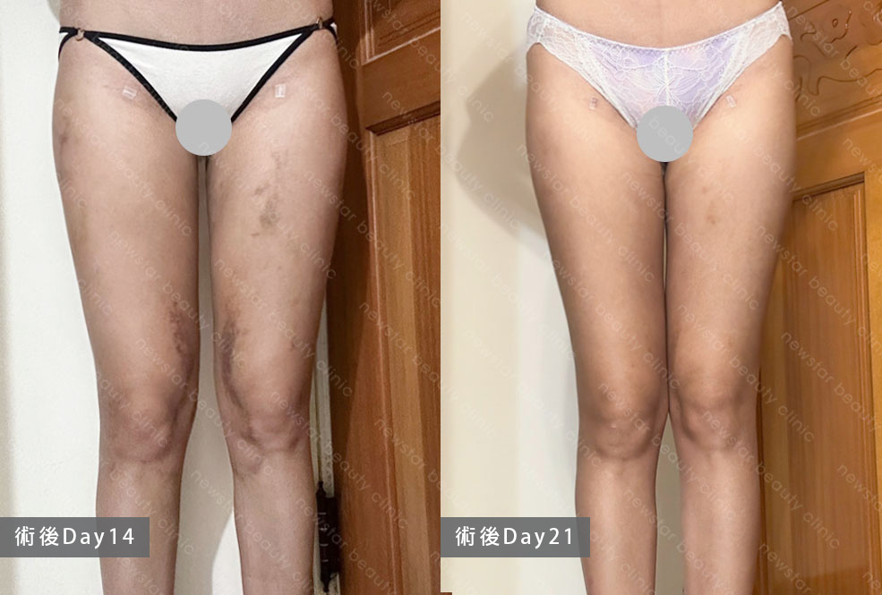 術後14-21day