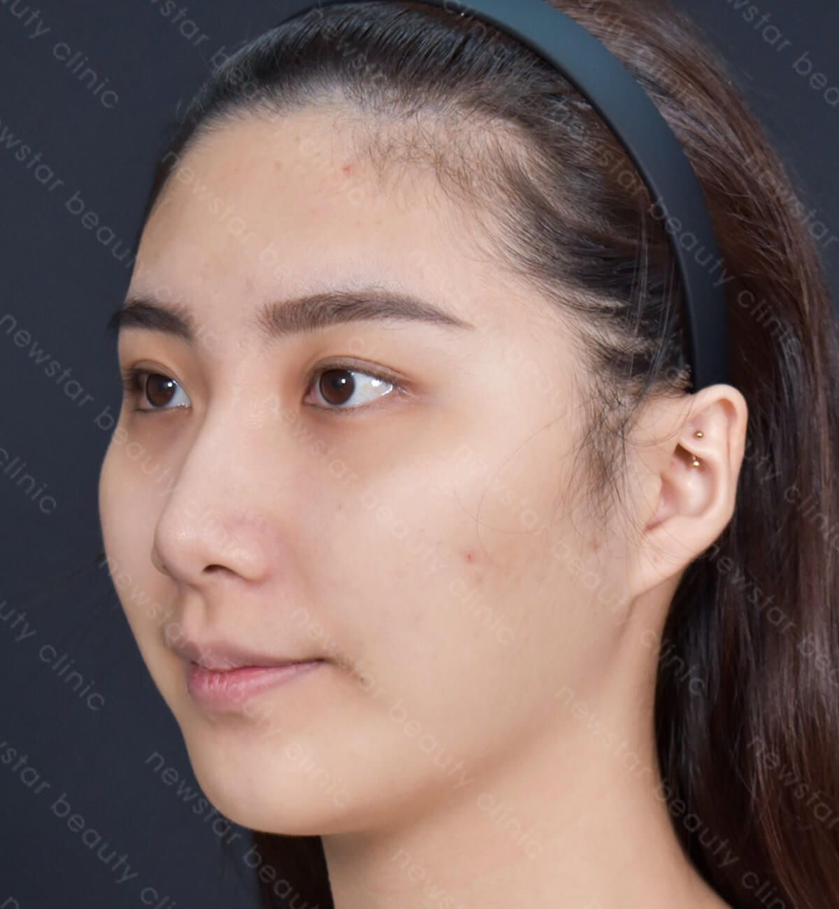 水光槍_術前案例
