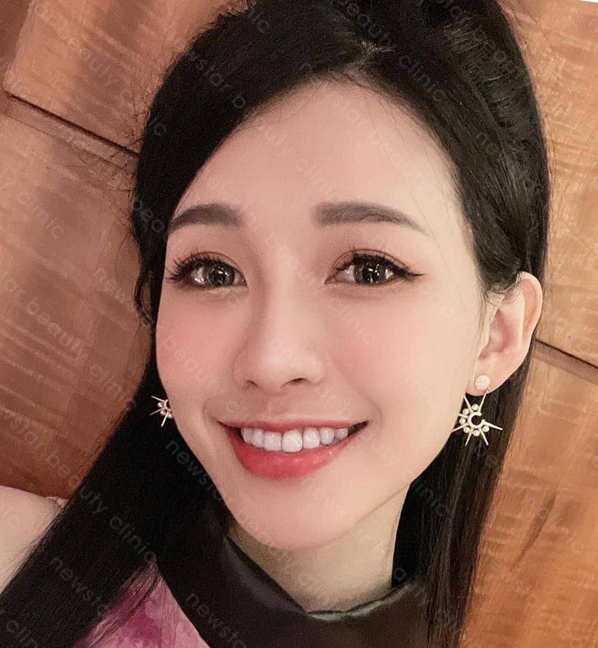 肉毒除皺_術後案例