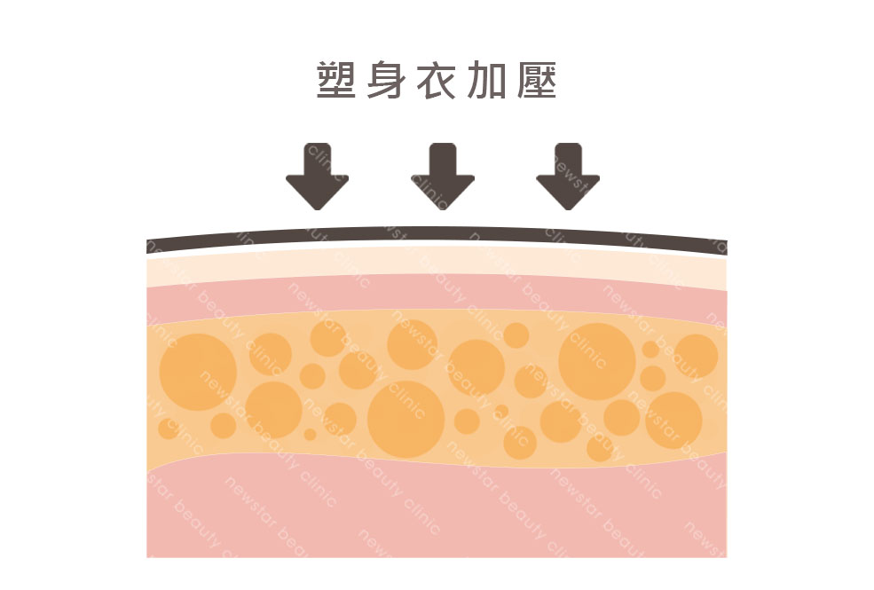 單張脂肪層(新版)_塑身衣加壓