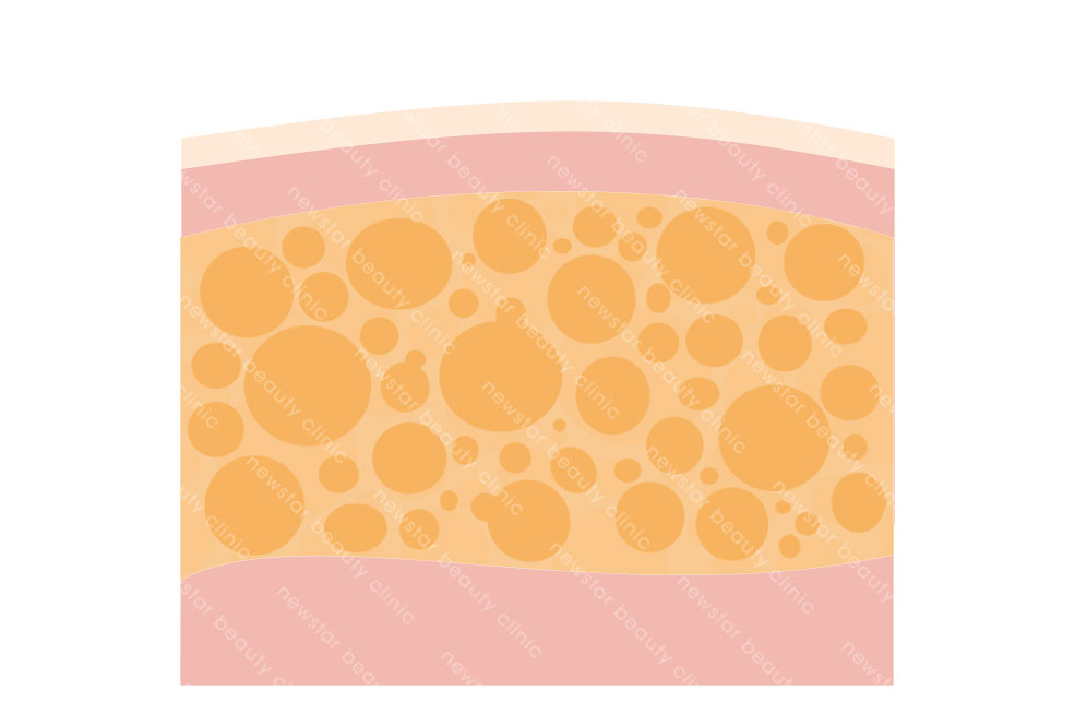 單張脂肪層(新版)_抽脂前