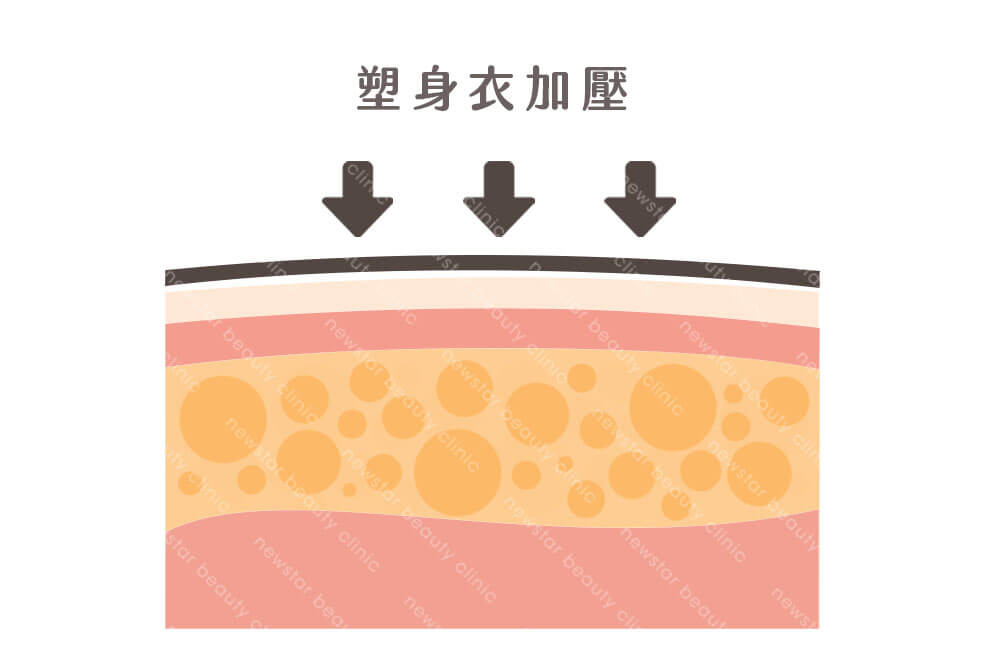 抽脂術後恢復_抽脂後