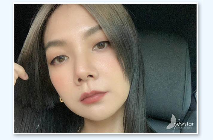 玻尿酸_案例封面(可比)