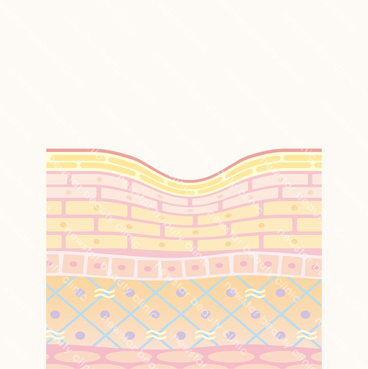 玻尿酸施打前，皮膚凹陷